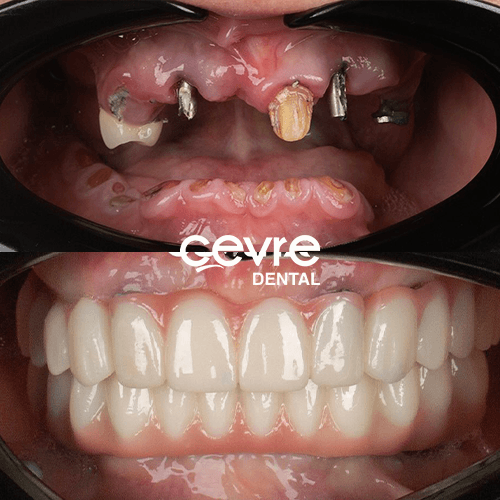 Dental Implants in Turkiye with Blue Medical Plus