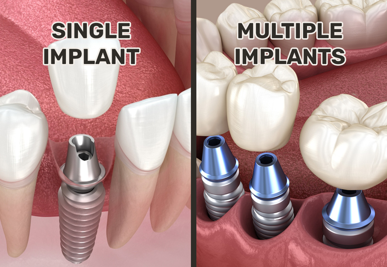 Single & Multiple Implants