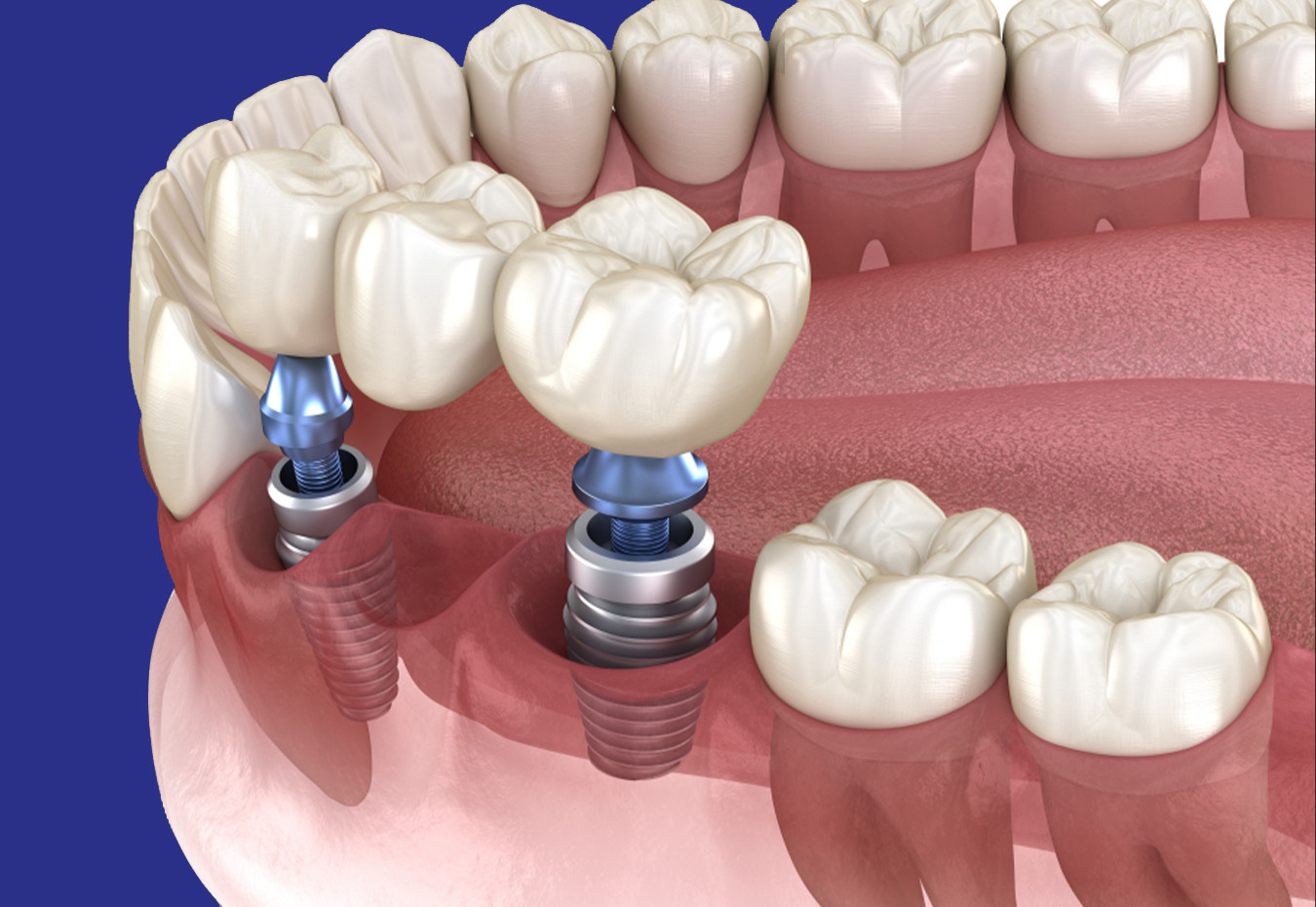 Implant-Supported Bridges
