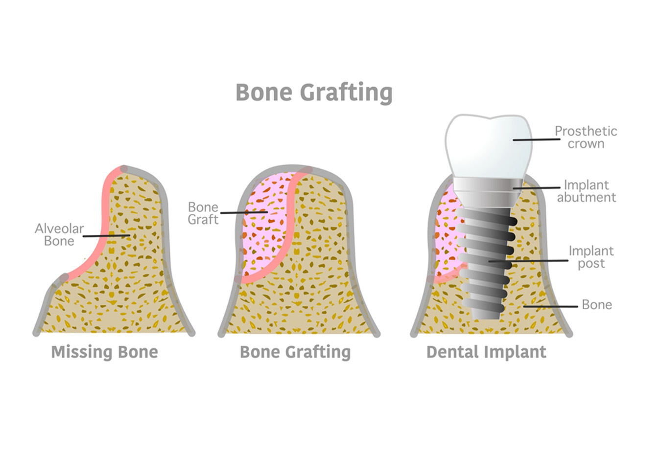 Bone Grafting & Sinus Lift