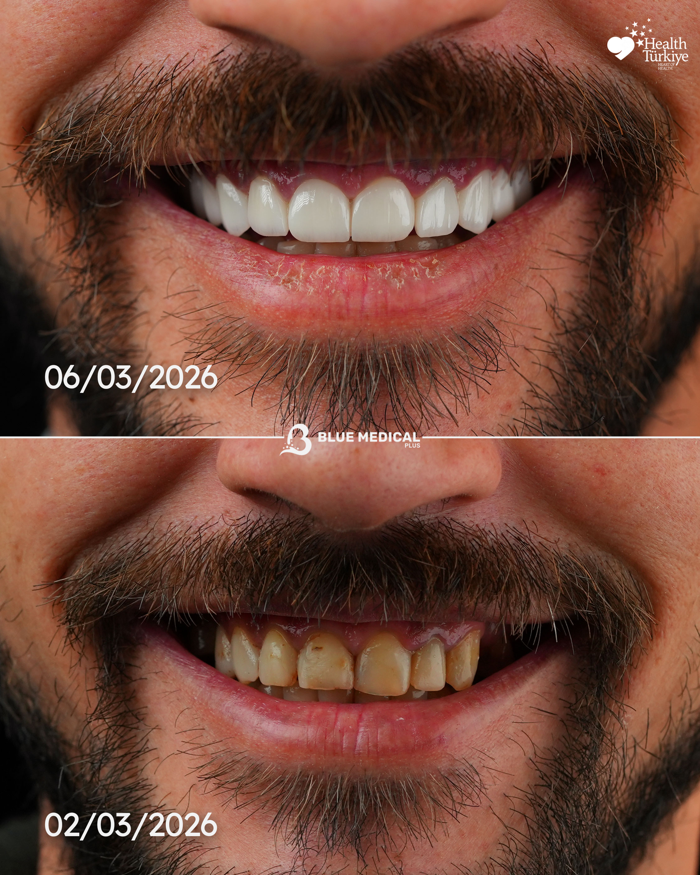 Before & After