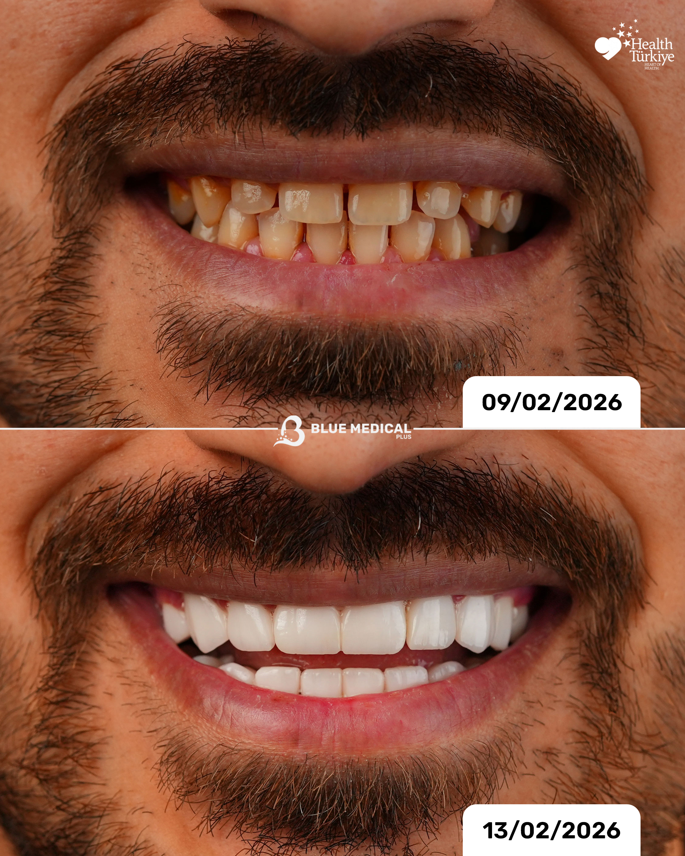 Before & After