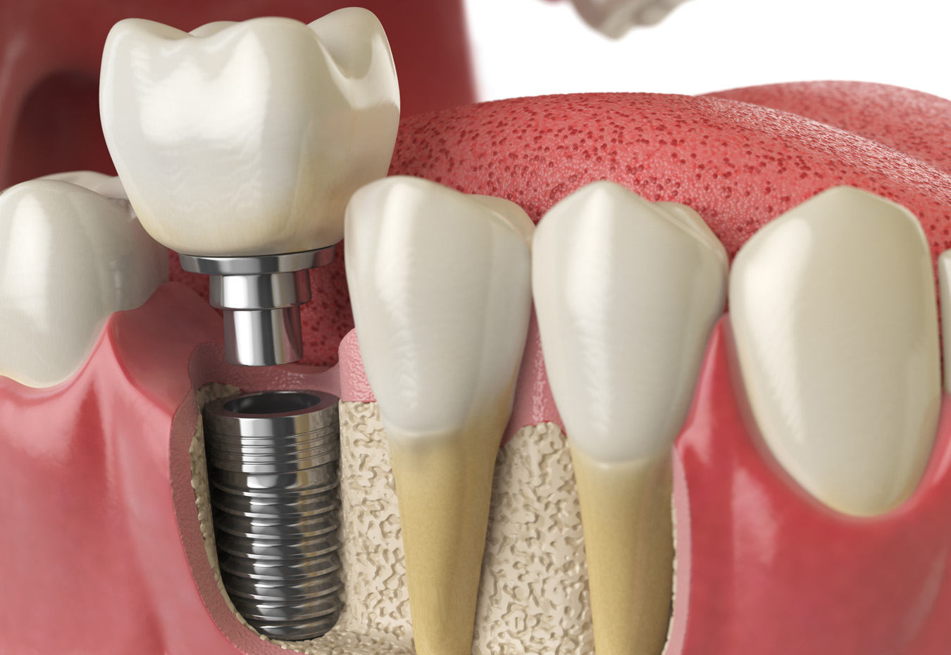 Dental Implants